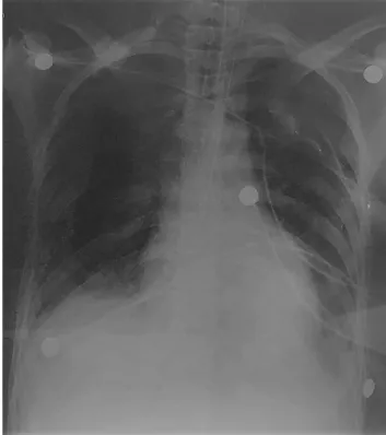 Fig. 1. Patient 2 - chest X-ray.