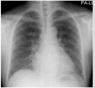 Figure 3.  Bilateral patchy and ground-glass opacities  completely resolved on a follow-up chest X-ray taken  five months after the open lung biopsy.