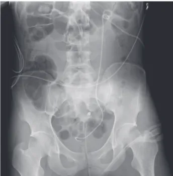Fig. 3. Segmental filling defects that imply hematoma were identified on nephrogram.
