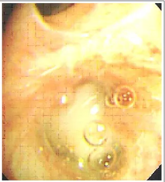 Figure 6.  Chronic granulomatous inflammation with  caseation  necrosis  is  seen  on  this  section  obtained  from pharynx
