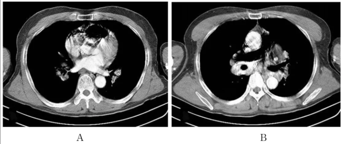 Figure 3.  High resolution CT scans obtained after 8 hours show no air in right ventricle (A) and main pulmonary  artery (B)