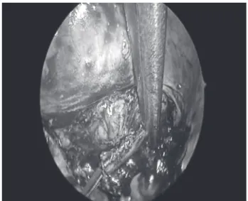 Fig. 1. Captured shot of the procedure showing the rib cut with total thoracoscopic methods using a Kerrison bone punch.