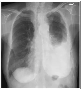 Figure 1.  Chest X-ray shows left pleural effusion and  left upper mediastinal mass with tracheal deviation.
