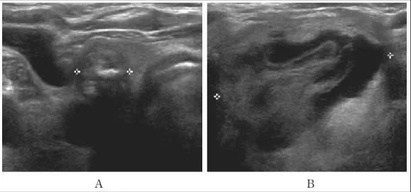 Figure 3.  Thyroid ultrasonography shows isoechoic mass measuring 1 cm in the right thyroid (A), and large  well-defined isoechoic mixed mass measuring 4.5 cm in the left thyroid (B).