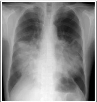Figure 2.  CT scan shows aggravated air-space con- con-solidation  ,  ground  glass  opacities  with  interstitial  thickening of interlobular septa in right middle lobe,  left lingular division and both lower lobes.