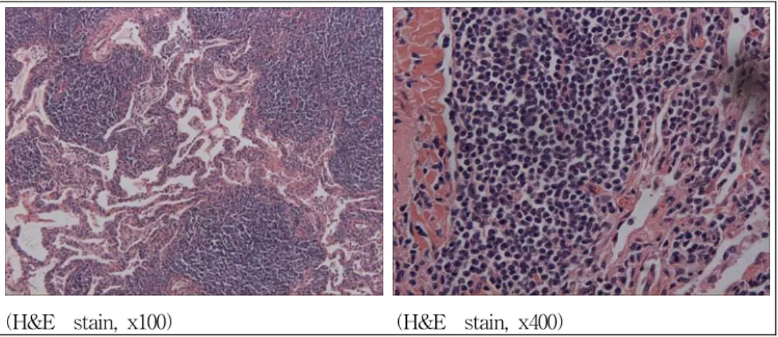 Figure  4.   Immunohistochemical  stain  for  CD  20  shows positive reation reactivity (x400).
