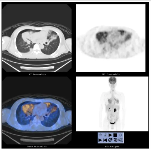 Figure 6.  PET CT shows multiple FDG uptake in right middle lobe, left lingular division, both lower lobe, both hilar,  right paratracheal and subcarinal lymph node.