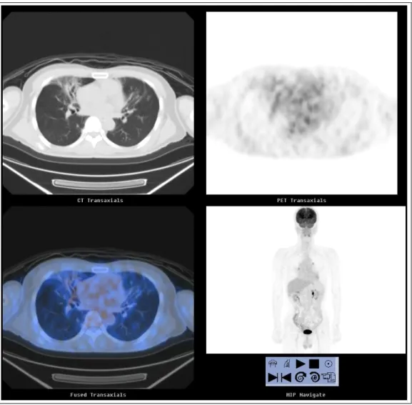 Figure 7.  PET CT shows the decreased  FDG uptake compared with previous study in right middle lobe and leff  lingular division