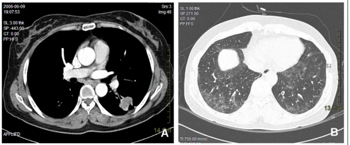Figure 2.  (A) A 3-cm enhancing mass showing air bronchogram and speculated margin with pleural tag is noted  in the superior segment of the left lower lobe