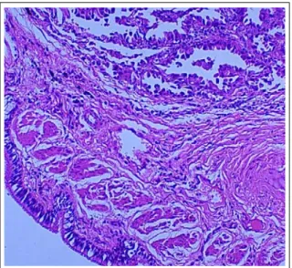 Figure 3.  The tumor lesion shows well-to-moderately  differentiated  neoplastic  cells  forming  acini  and  tubules  composed  of  cuboid  cells,  suggesting  adenocarcinoma