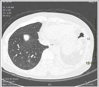 Figure  5.   There  is  left  lower  lobectomy  state,  and  previous  ground-glass  opacity  on  figure  2B  is  not  noted in the right lower lobe.