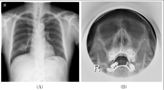 Figure 1.  (A) An initial chest X-ray showed a soft tissue mass, approximately 4.5 cm in diameter, in the right  lower lung field