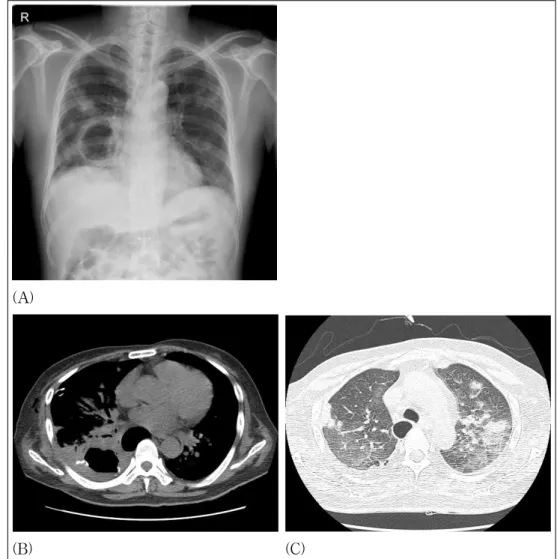 Figure 5.  (A) A follow up chest X-ray showed increased size of the cavitary lesion in the right lower lung, with  multifocal ill-defined opacities in both lungs