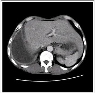 Figure  1.   Diffuse,  intermittent,  and  smooth  pleural  enhancement  pattern  in  a  58-year-old  man  with  a  tuberculous pleural effusion on the contrast-enhanced  CT  scan  (ADA  level,  46  U/L)