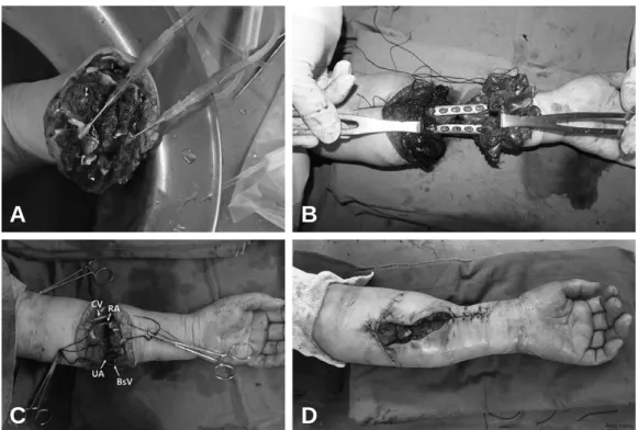 Fig. 1. (A) Flushing of severed forearm was performed through radial artery (RA), ulnar aryery (UA) with cold heparinized Hartmann’s solution; (B) The internal fixation of both ulna and radius was done by end to end with plate fixation; (C) Vascular recons