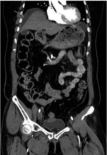 Fig. 3. Retrograde cystography showing an intraperitoneal leak- leak-age of radiologic contrast (arrow) suggesting  intraperi-toneal rupture of bladder.