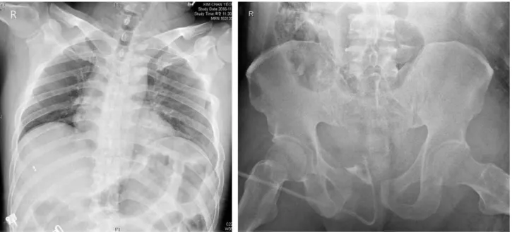 Fig. 1. Multiple contiguous rib fractures with hemothorax was seen on left chest and APC type II injury was seen on Pelvis AP view.