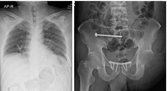 Fig. 5. Postoperative x-rays of chest and pelvis AP.