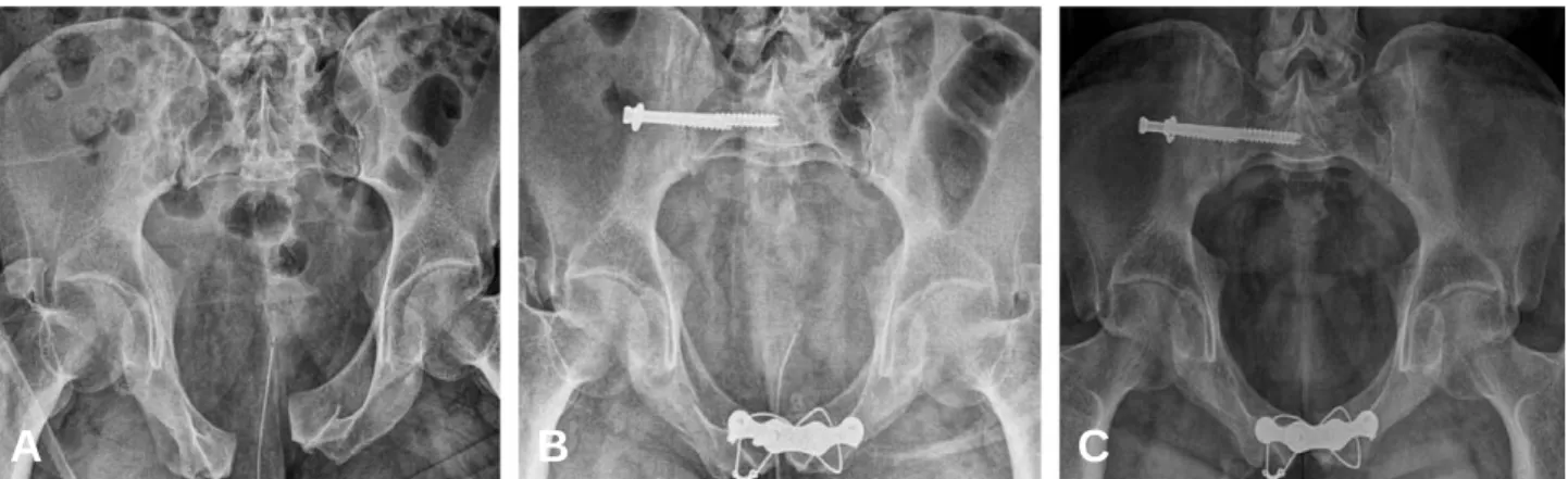 Fig. 3. Plain inlet pelvis radiograph (A) Preoperative image of a 36 year old male after pelvic ring injury (61-B1), (B) A Postoperative image showed anterior fixation by 4.5 mm SP plate with TBW and posterior fixation by iliosacral screw for right S-I joi