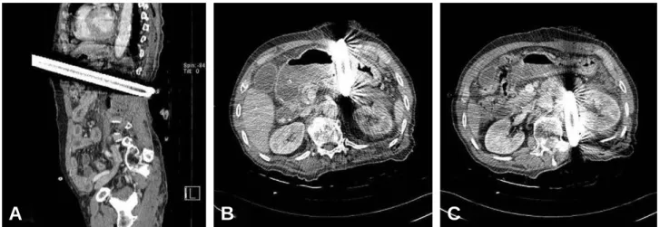 Fig. 2. On abdomen computerized tomography, 3 cm sized pipe was penetrated the body of stomach and abutted on left renal vessels.