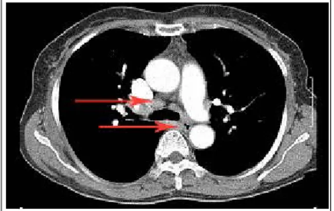 Figure  1.   Chest  computed  tomography  showed  bilateral  hilar  lymphadenopathy  (red  arrows)  and  parenchymal tiny nodules.