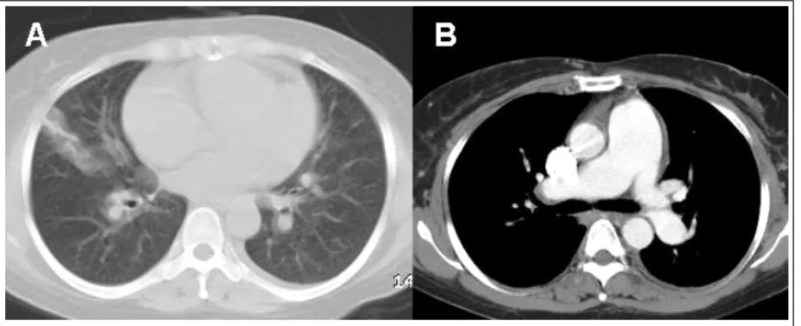 Figure 2.  Chest computed tomography scan on admission showed the consolidative pneumonic infiltration in right  lower lobe (A) and dilatation of pulmonary trunk without evidences of pulmonary thromboembolism (B).