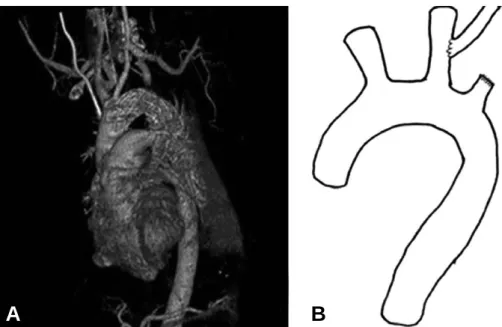 Fig. 1. TEVAR with Subclavian carotid bypass for a patient with traumatic aortic injury: (A) Postoperative computed tomography scanning shows TEVAR and Lt