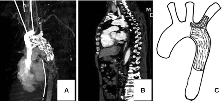 Fig. 2. TEVAR using the chimney technique for a patient with traumatic aortic injury: (A) &amp; (B) Postprocedural computed tomogra- tomogra-phy scanning shows TEVAR with chimney technique in Lt