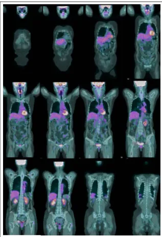 Figure  1A.   Consolidation  combined  with  linear  opacities was noted on left upper lobe.