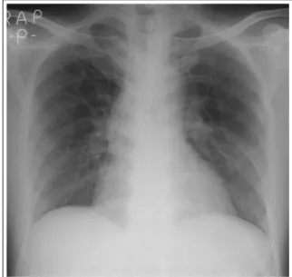 Figure 2.  On hospital day 2, the chest radiography  reveals improvement of the consolidations in the both  lung fields.