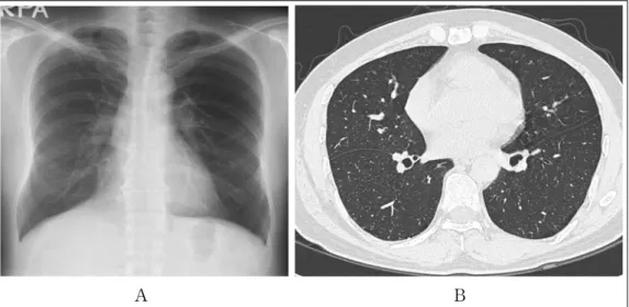 Figure 4.  (A) On the chest radiography after 4 months, the consolidations and ground glass opacities had been  disappeared