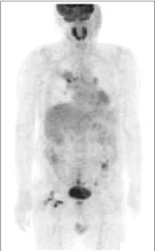Figure  3.   Ultrasonography  of  liver  shows  an  about  1.91  cm-sized  hypoechoic  mass  with  indistinct  margin, which includes echogenic portion