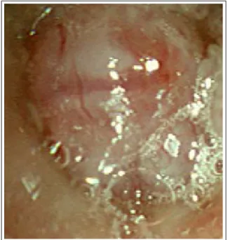 Figure 5.  Bronchoscopy shows a mass occluding the  orifice of anterior segmental bronchus of right upper  lobe