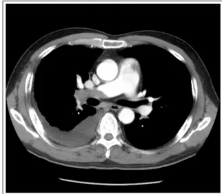 Figure  1.   Chest  PA  shows  ill  defined  consolidation  and ipsilateral pleural effusion in right hemithorax