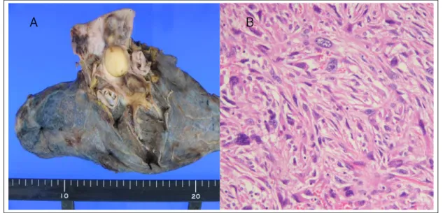Figure 4.  Exisioned lung shows yellowish round mass obstructing right main pulmonary artery(A) and histologic  finding shows malignant fibrous histiocytoma with a background of spindle cells in a storiform configuration and  giant cells (H&amp;E staining,
