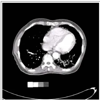 Figure 2.  After 5 th  chemotherapy, computed tomogra- tomogra-phy shows marked resolution of primary tumor in the  ekf