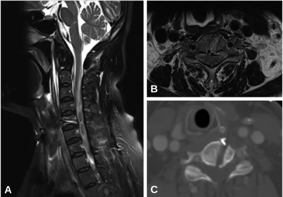 Fig. 3. (A, B) MRI reveals a bony defect of 5 th cervical spine and abnormal high signal intensity from cervicomedullary junction to 2 nd thoracic spine, which implies extensive myelopathy of spinal cord