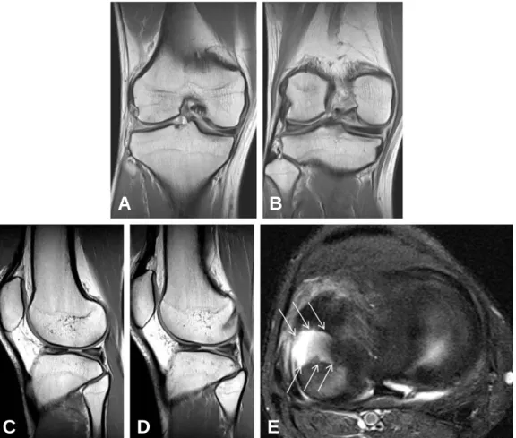 Fig. 1. Initial coronal (A, B), sagittal (C, D), and axial (E) MR images of the right knee show a large radial tear in the body of the lateral meniscus, with underlying incomplete discoid meniscus morphology (arrows).