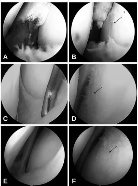 Fig. 2. Initial arthroscopic findings (A, B) show a complete radial tear of the body of the lateral meniscus