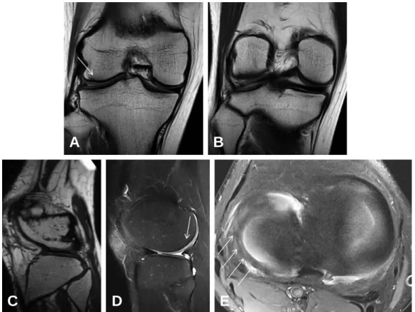 Fig. 3. Proton-density coronal (A, B), sagittal without and with fat-saturation (C, D), and axial (E) MR images show small but con- con-tinuous lateral meniscus without the radial defect (arrows) at thirteen months after surgery