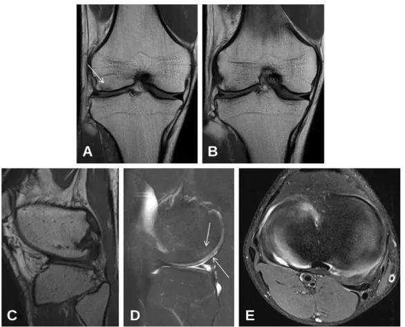Fig. 4. Proton-density coronal (A, B), sagittal (C, D), and axial (E) MR images show no interval change of the thinly spread appear- appear-ance of the lateral meniscus