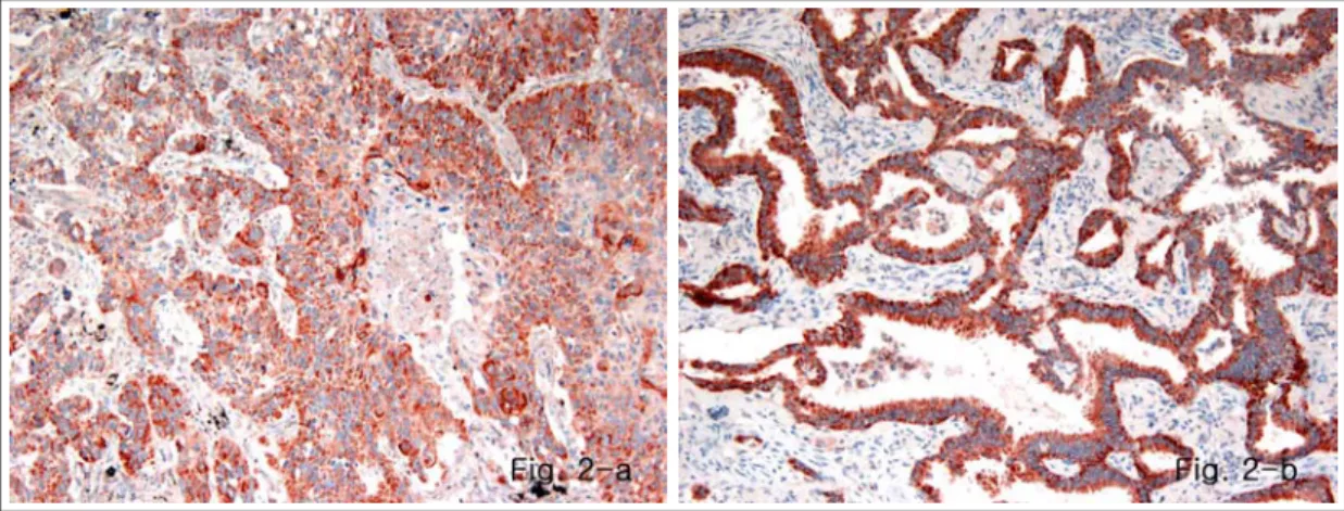 Table 2. Immunohistochemical expression of C-erbB-2 and VEGF in squamous cell carcinoma of NSCLC by  stage