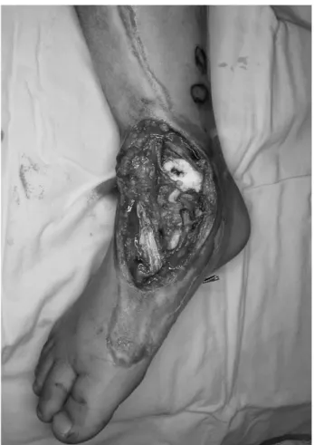 Fig. 2. The adipofascial flap covers the defect after turning down. The adiposal plane is facing the defect site