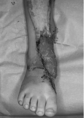 Fig. 4. After 10 days postoperatively, the flap is survived and well-formed granulation tissue covers the flap