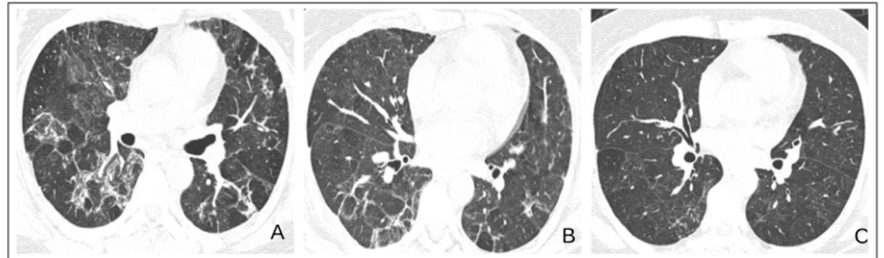 Figure 2.  Chest radiograph shows diffuse ground glass opacity and reticular opacity in the both lungs (A)