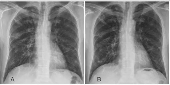Figure 1.  Initial Chest PA shows bilateral multifocal ill-defined peripheral dominant consolidations, nodules and  reticular opacities (A)