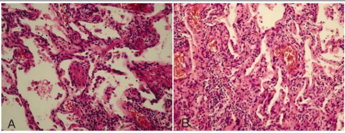 Figure 4.  Histologic findings of open lung biopsy. These microscopic findings show mild to moderate chronic  interstitial inflammation, containing lymphocytes and a few plasma cells, in a uniformed pattern