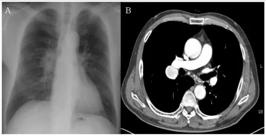 Figure 1.  Chest roentgenogram on admission. About 3.5 cm sized, well-defined, mass like opacity is noted in Rt