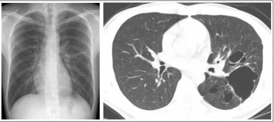 Figure 2.  (A) Left lower lobectomy specimen shows a large lung cyst without communication with bronchus