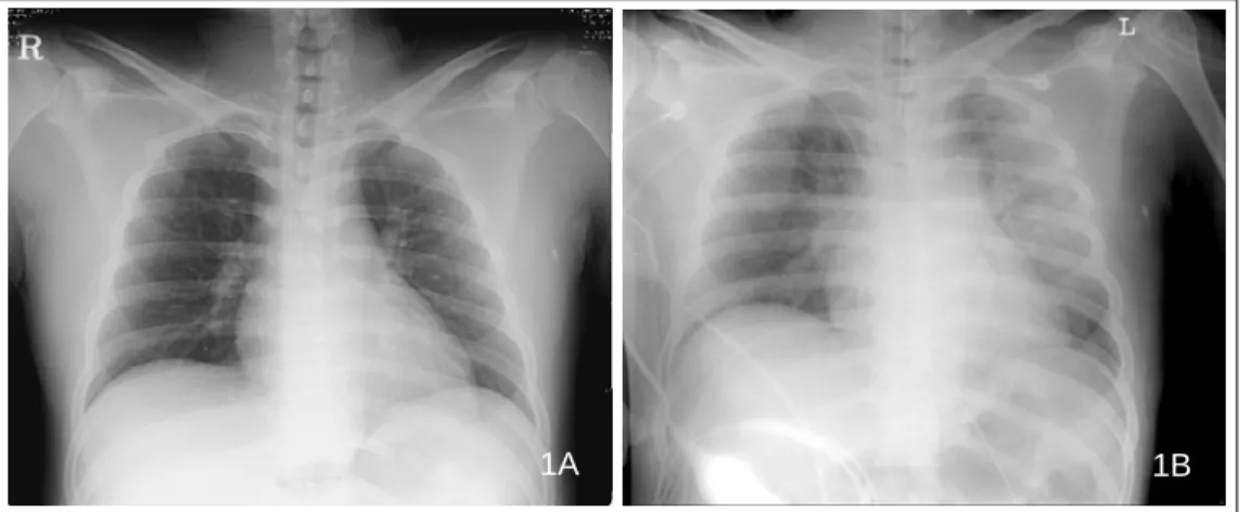Figure  2.   Chest  CT  shows  bilateral  diffuse  consoli- consoli-dations with ground glass opacities predominantly on  dependant portions.
